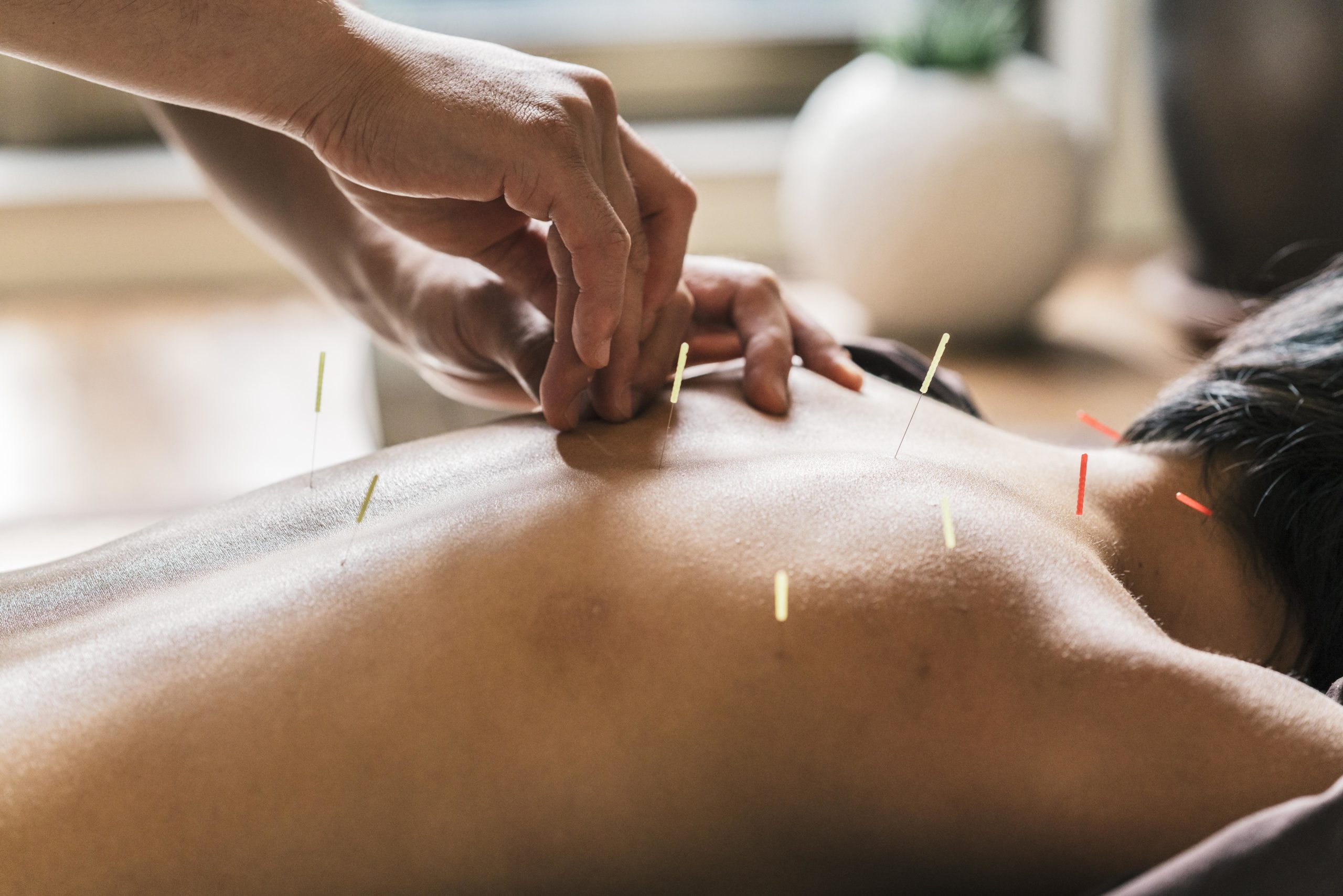 Therapist Giving acupuncture Treatment To a Japanese Woman Acupuncture Therapy