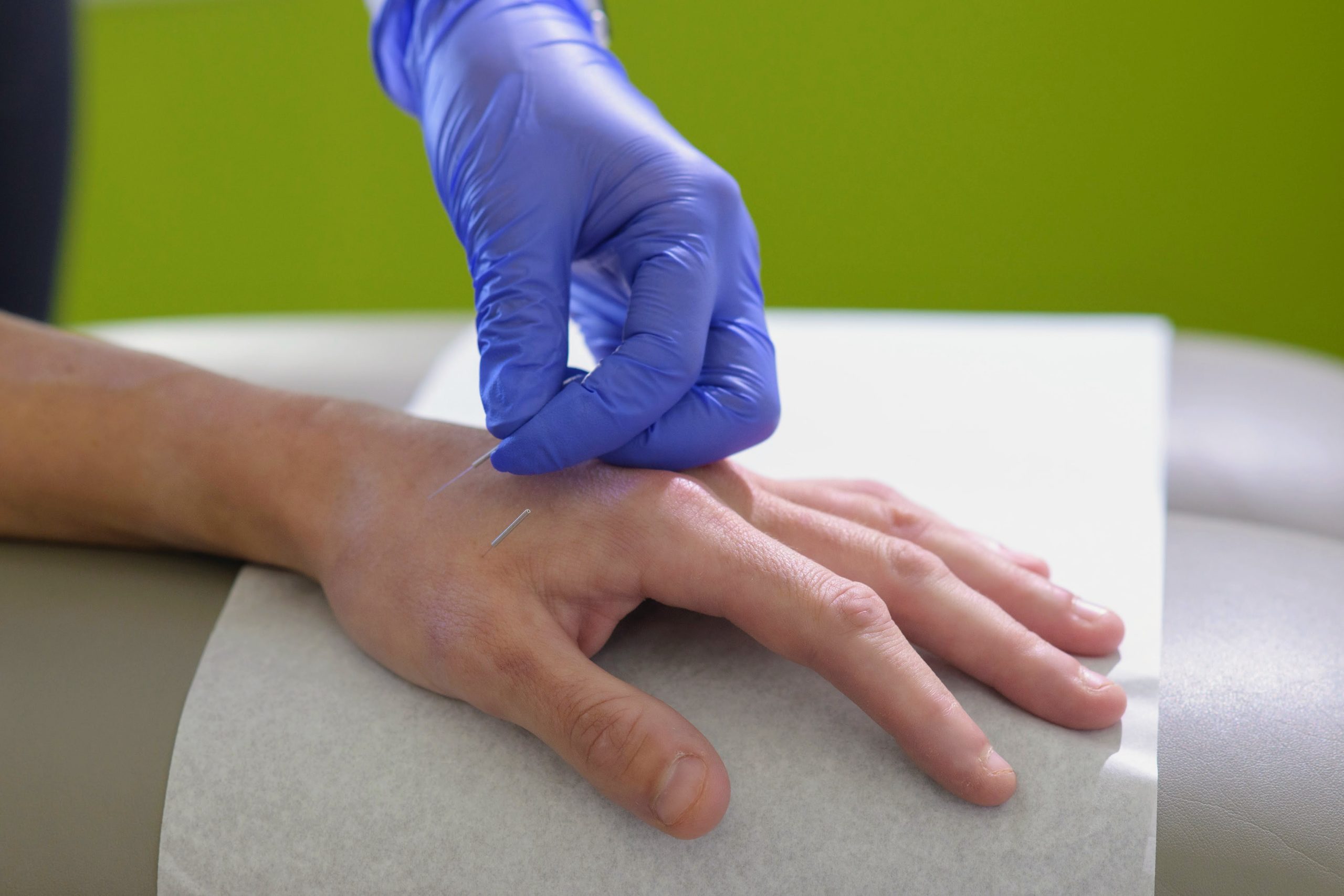 Acupuncture of a hand