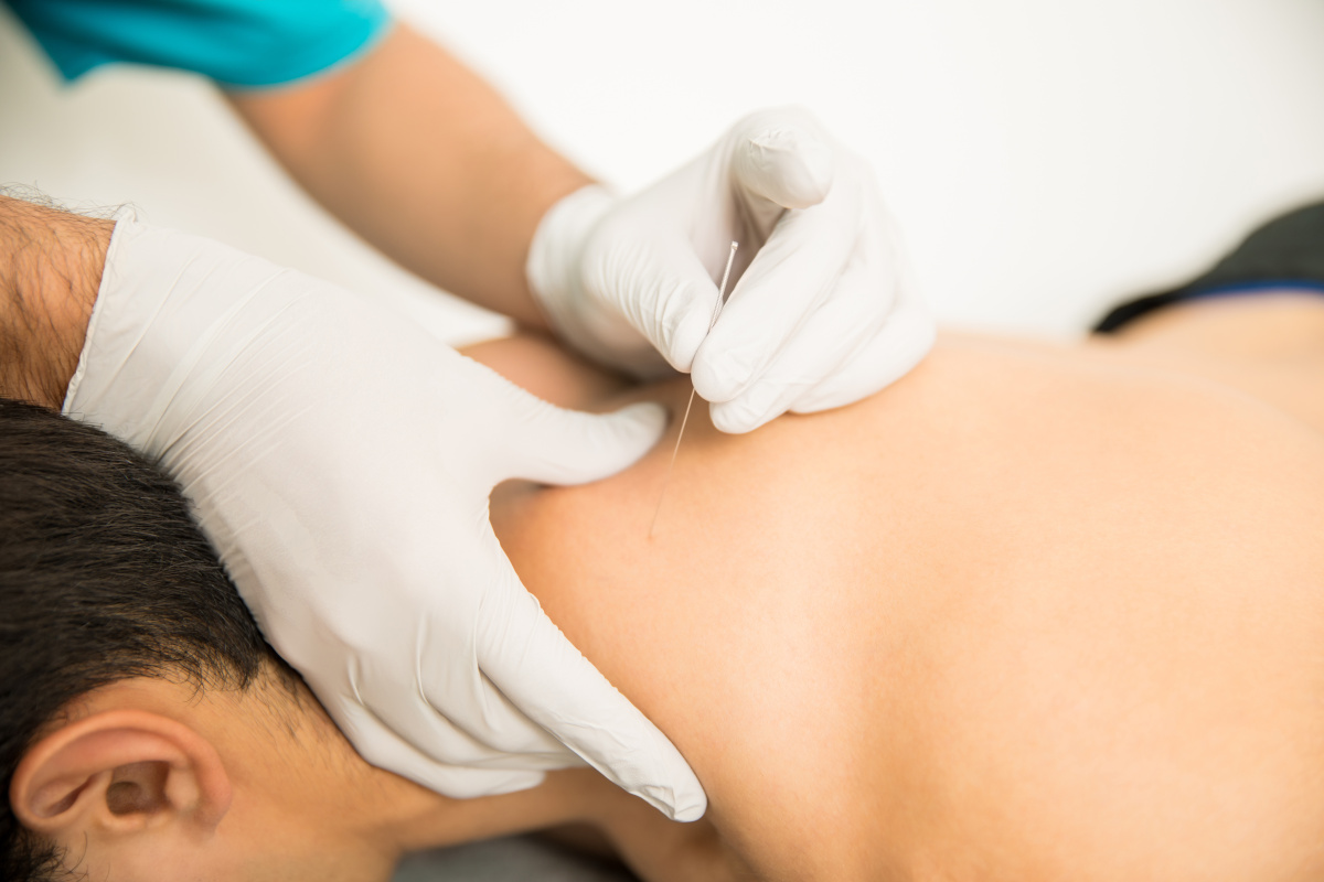 Dry Needling therapy - is similar to Acupuncture therapy