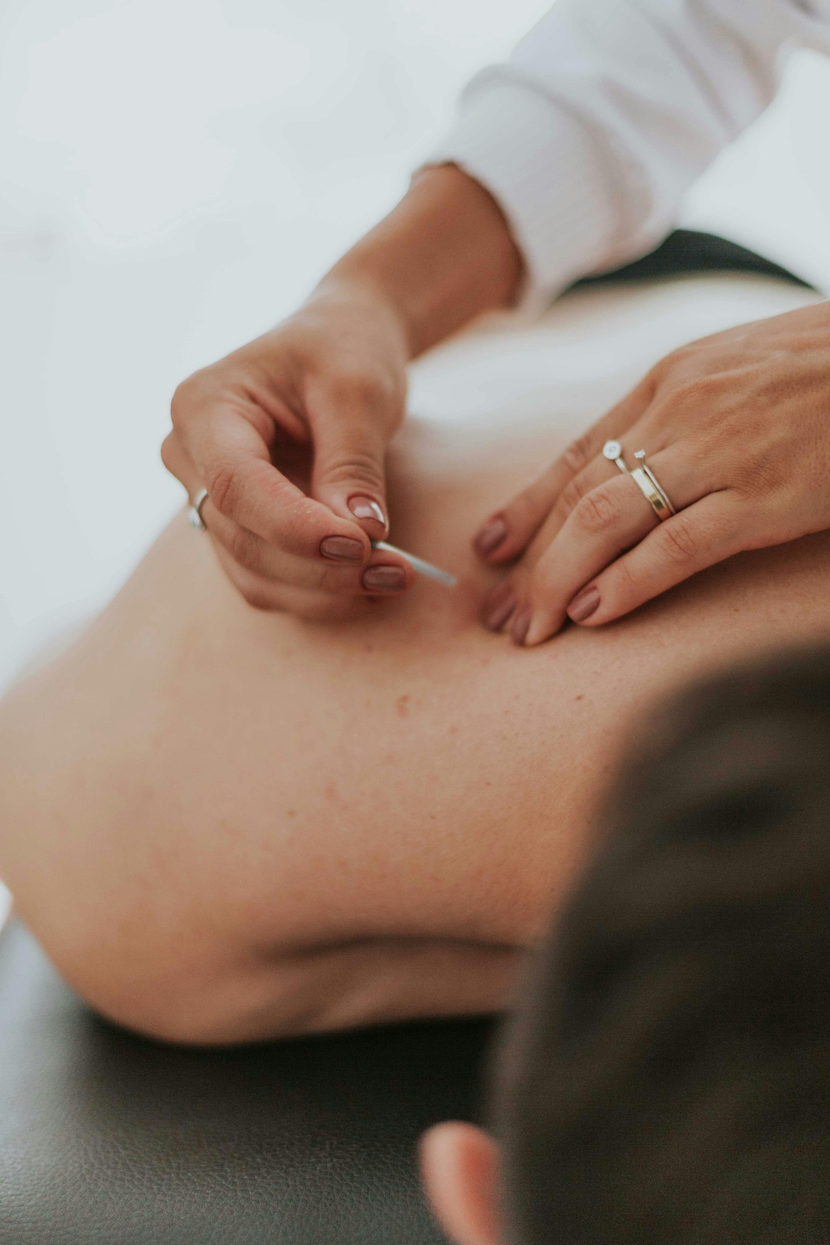 Dry Needling offers targeted pain relief